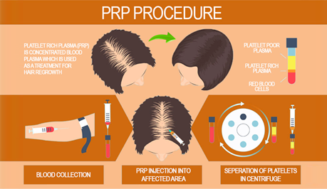 prp-procedure