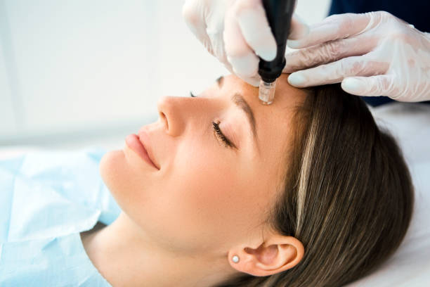 Dermapen skin needling Best microneedling services